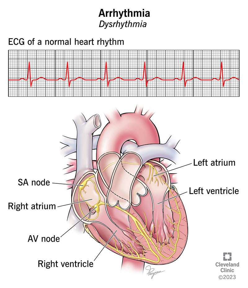 16749-arrhythmia-illustration