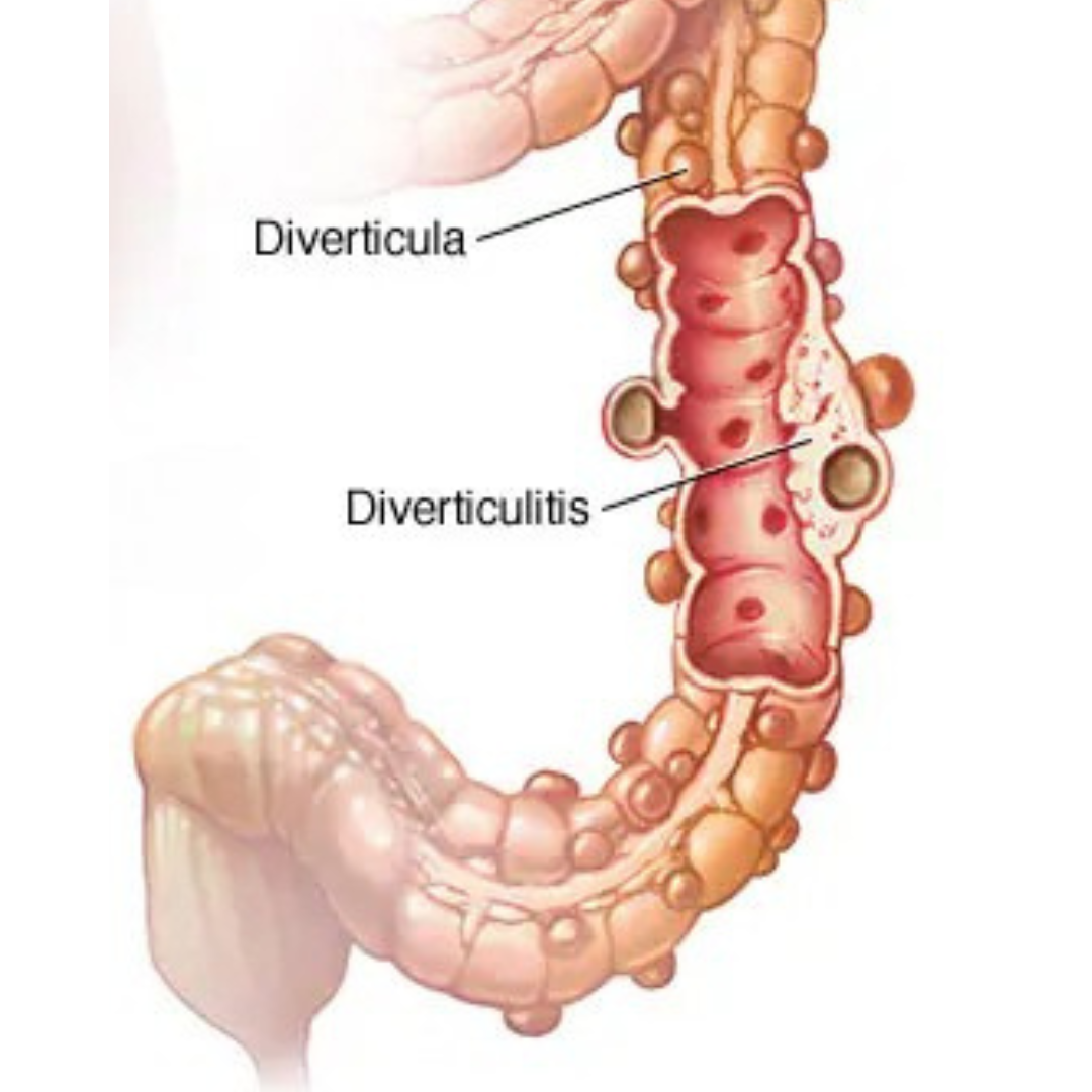 diverticuloss