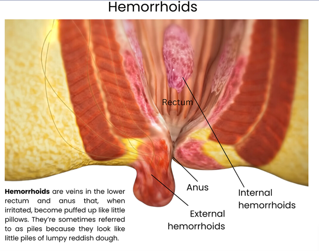hemorroids hemorroids